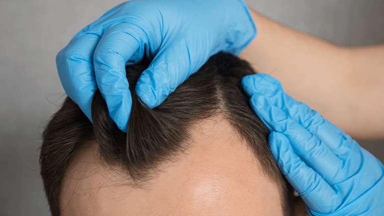 Hair Transplant London – Achieve a Fuller, Natural Look
