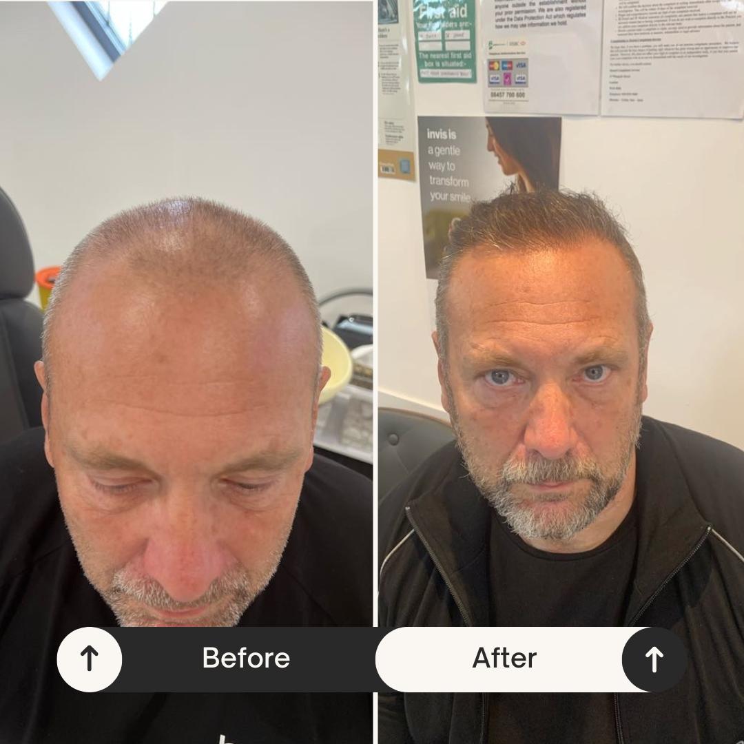 Leading Hair Transplant London Surgeons at Westminster Medical Group®